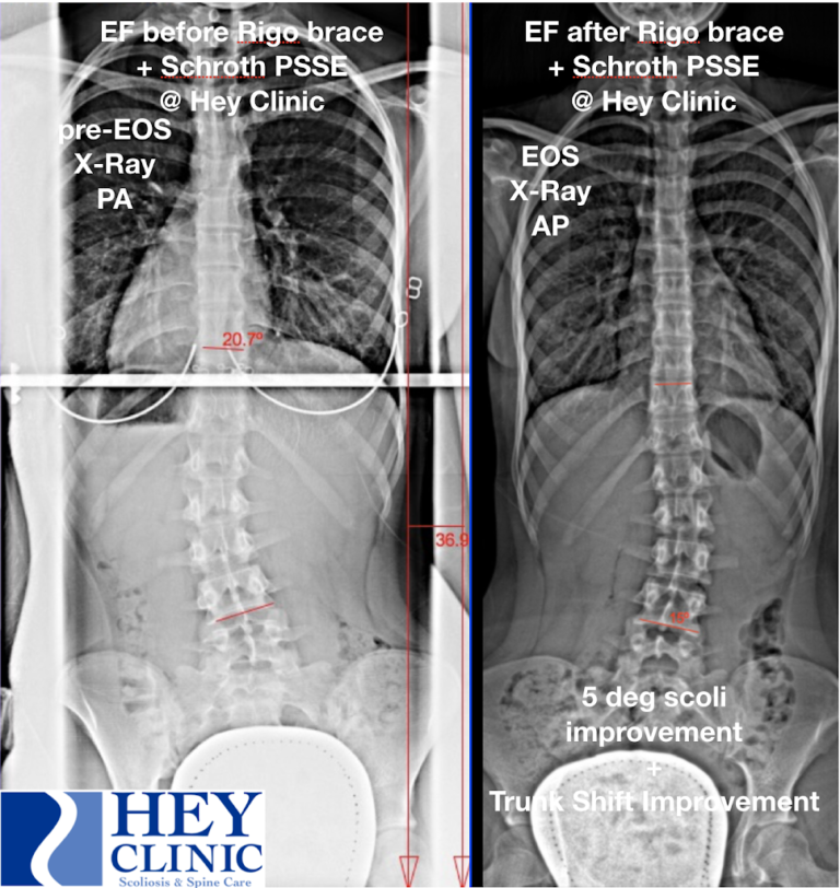 Can My Adolescent Idiopathic Scoliosis Curve And Posture Actually ...