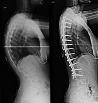 Kyphosis | HeyClinic