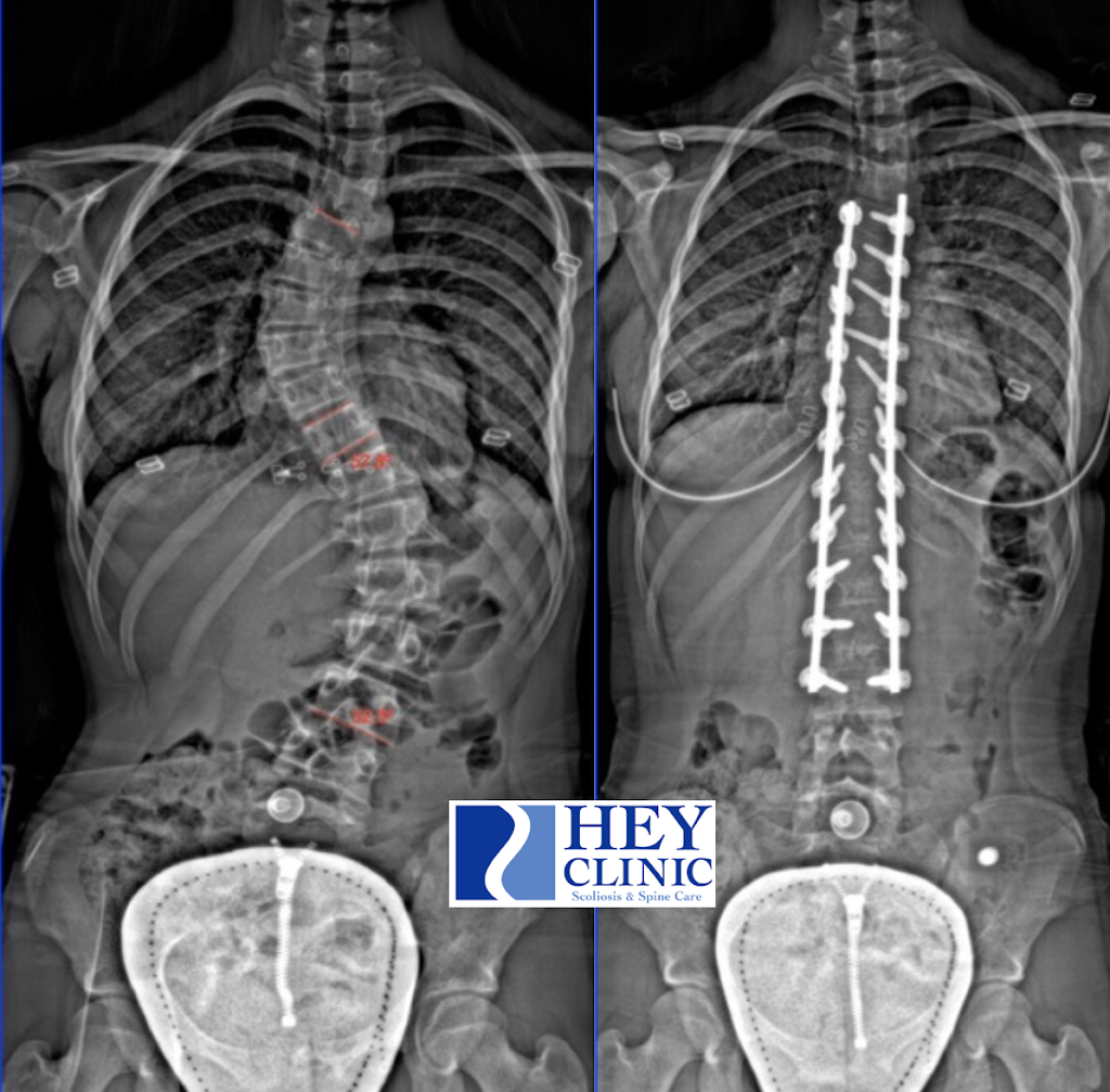 Scoliosis Awareness Month Spinal Fusion Lumbar Throw Pillow by NAO
