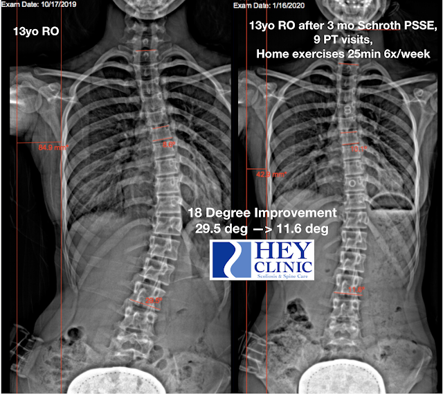 Schroth Therapy Reverses Scoliosis Curve! - Hey Clinic