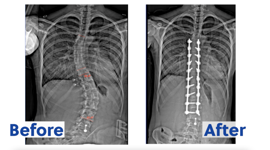 Free from Back Pain After Scoliosis Surgery
